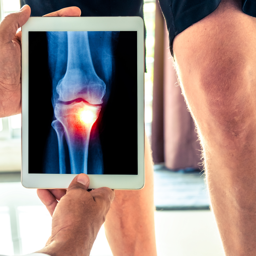 What Type of Doctor to See for Knee Pain?