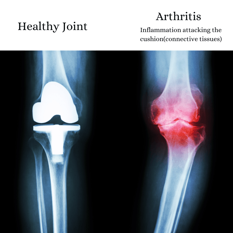 Comprehensive Arthritis support - Yuregen